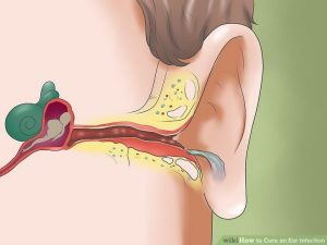عفونت گوش2 300x225 - آنچه باید از عفونت گوش بدانیم.