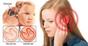 عفونت گوش3 1 300x157 - آنچه باید از عفونت گوش بدانیم.