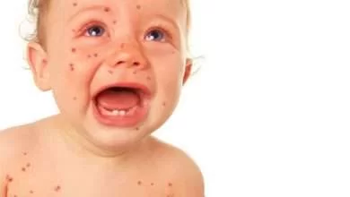Rash startImage 390x220 - علائم نگران کنند در پوست صورت نوزادان
