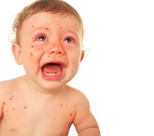 Rash startImage 532x470 - علائم نگران کنند در پوست صورت نوزادان