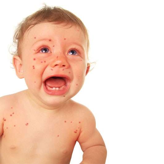 Rash startImage - علائم نگران کنند در پوست صورت نوزادان