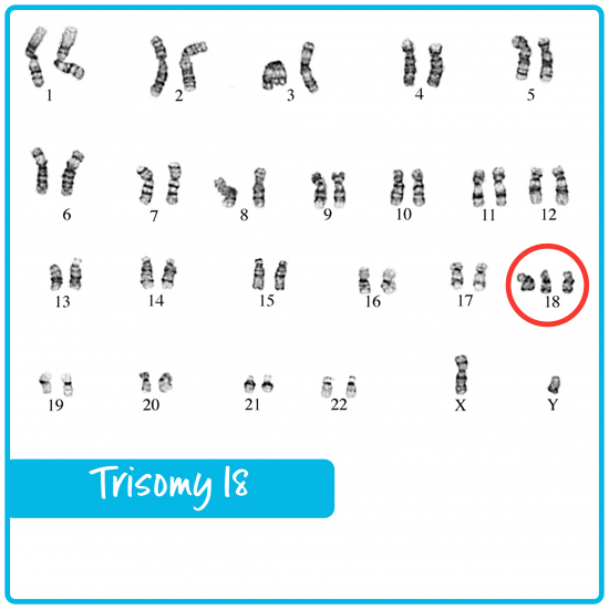 15 - سندرم ادواردز, تریزومی 18