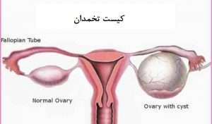 2018 7large ovarian cysts 2 300x176 - 2018_7$large_ovarian_cysts-2