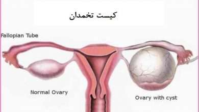 2018 7large ovarian cysts 2 390x220 - آیا کیست تخمدان می تواند تبدیل به سرطان شود ؟