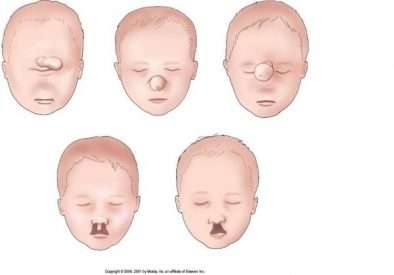 8d28a72cf07aec0320ab3bb0bcf09070 patau syndrome cyclopia visicom yahoo image search results patau syndrome drawing 1023 714 e1534269079906 - سندرم پاتو یا تریزومی ۱۳ چیست؟