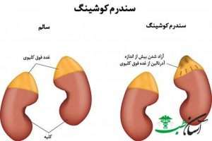 Cushings syndrome2 300x200 - Cushings-syndrome2