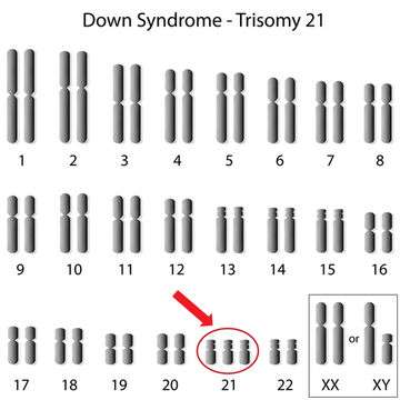 Down syndrome karotype - سندرم داون، تریزومی های دوست داشتنی
