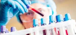 تفسیر آزمایش خون 2 blood test 300x138 - تفسیر آزمایش خون 2