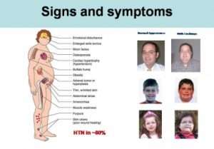 cushings syndrome 300x209 - سندرم کوشینگ چیست؟