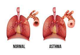 images 1 3 - مواد غذایی که برای تسکین علائم بیماری آسم تجویز می گردد.