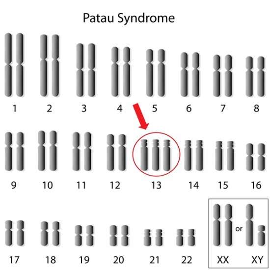 trisomy 13 karyotype - سندرم پاتو یا تریزومی ۱۳ چیست؟