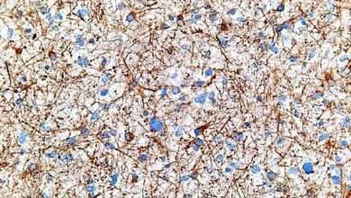 تصویر میکروسکوپی از سلول های سرطان مغزی