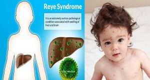 Reyes syndrome 2 300x161 - Reyes-syndrome