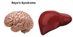 Reyes syndrome 300x152 - Reyes-syndrome