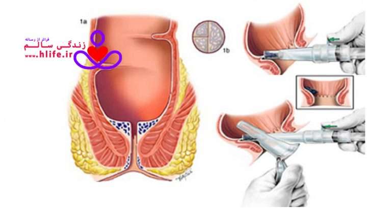 hemorrhoidsurgery 720x413 - بواسیر خارجی چیست؟ علل، علائم و درمان بواسیر خارجی (هموروئید خارجی )