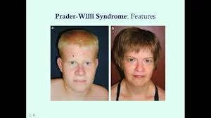 pws syndrome - سندرم پرادرویلی چیست؟