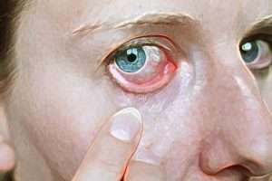 red eye stylized khoshki cheshm darman jarahi cheshm 300x200 - خشکی چشم ، علل و راهکارهای درمان آن
