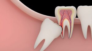 دندان عقل 300x169 - دندان عقل