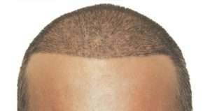 hlife.1 5 300x159 - روش‌های کاشت مو
