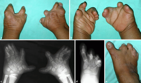 داکتیلی - سین داکتیلی یا چسبیده بودن مادرزادی انگشتان دست چیست؟