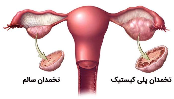 تنبلی تخمدان یا تخمدان پلی کیستیک