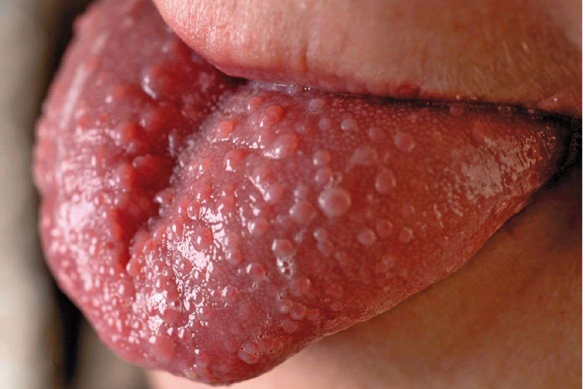 afb beeldquiz 7 - هرپس تناسلی، یکی از شایع ترین بیماری های جنسی