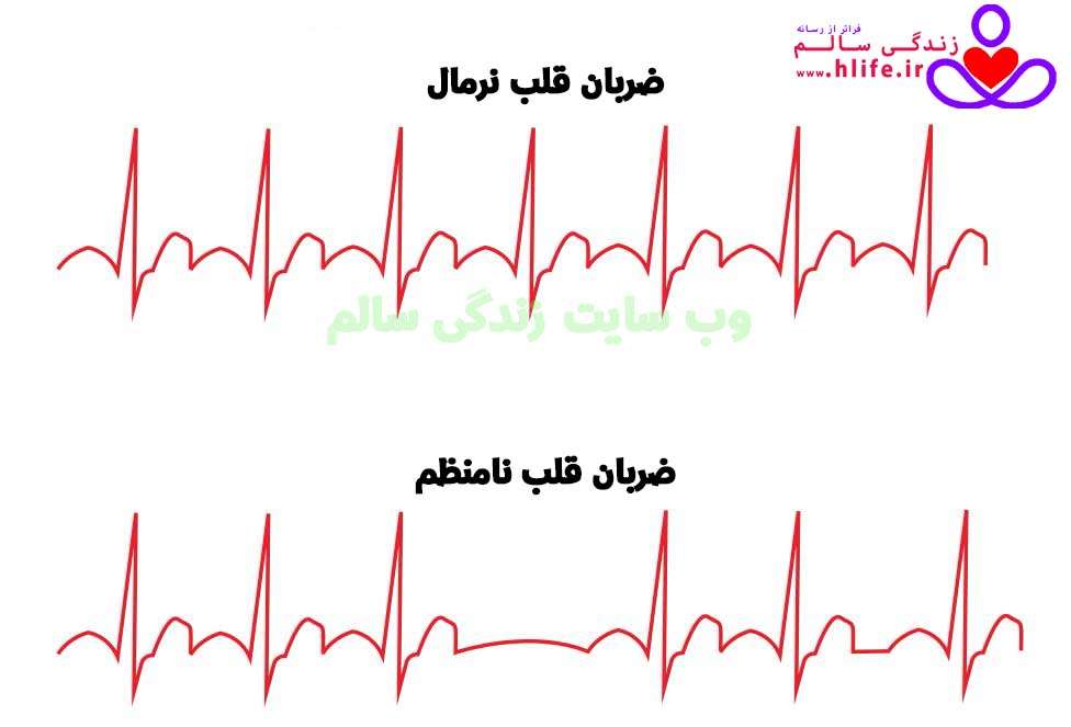 12285 - آریتمی قلبی PVC : علت و نشانه های آن