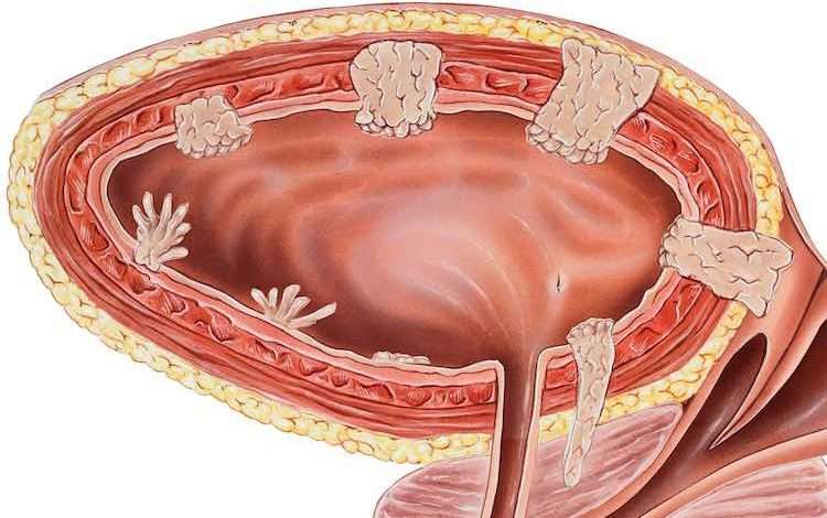 Cancer of the urinary bladder and bladder wall, cutaway side view. سرطان مثانه