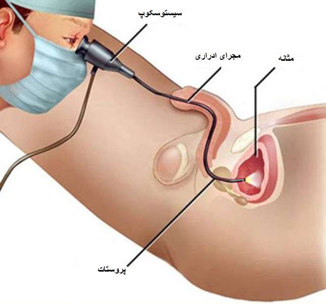 cystoscopy1 - سرطان مثانه : علائم، تشخیص و روش های درمان آن