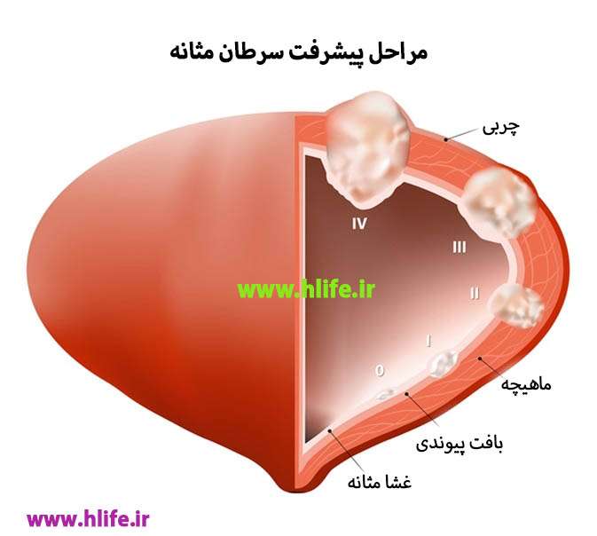 hlife - سرطان مثانه : علائم، تشخیص و روش های درمان آن