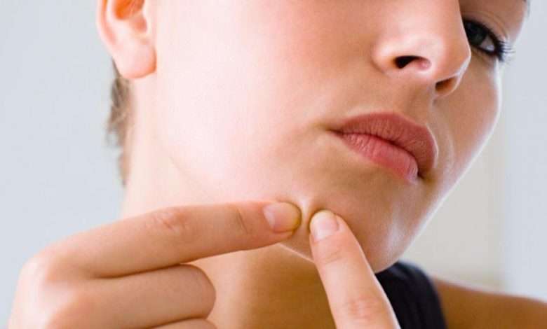 970 Can you Wear makeup over a popped pimple 780x470 - جوش بلوغ؛ 10 راهکار برای از بین بردن جوش جوانی