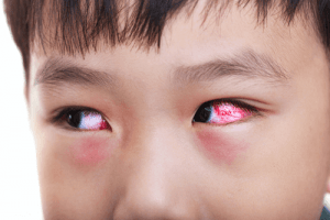 kawasaki disease red eyes 300x200 - kawasaki-disease-red-eyes