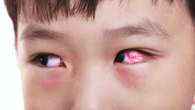 kawasaki disease red eyes 390x220 - سندرم کاوازاکی؛ تشخیص، درمان و زندگی روزمره