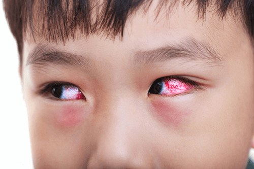 سندرم کاوازاکی؛ تشخیص، درمان و زندگی روزمره kawasaki disease red eyes - سندرم کاوازاکی؛ تشخیص، درمان و زندگی روزمره