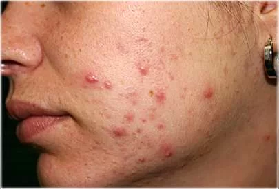 moderate acne - جوش بلوغ؛ 10 راهکار برای از بین بردن جوش جوانی