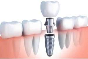 Croasdaile Dental Arts dental implants 300x200 - Croasdaile-Dental-Arts-dental-implants