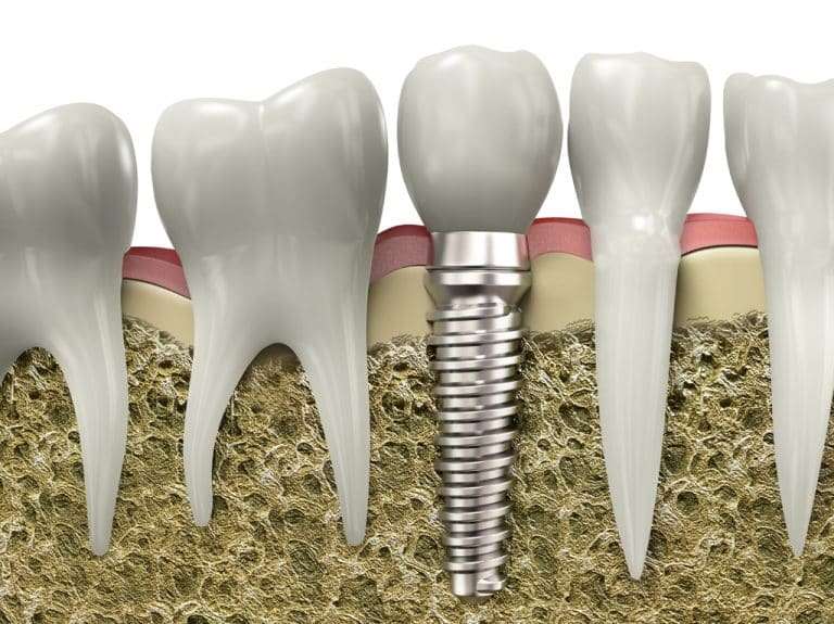 implant 768x575 - ایمپلنت دندان : و هرآنچه در مورد ایمپلنت باید بدانید