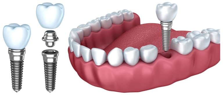 implant-price-768x329 ایمپلنت دندان