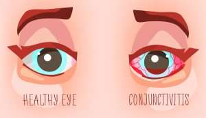 1140 pink eye conjunctivitis 300x172 - An illustration that shows a healthy eye on the left and an eye