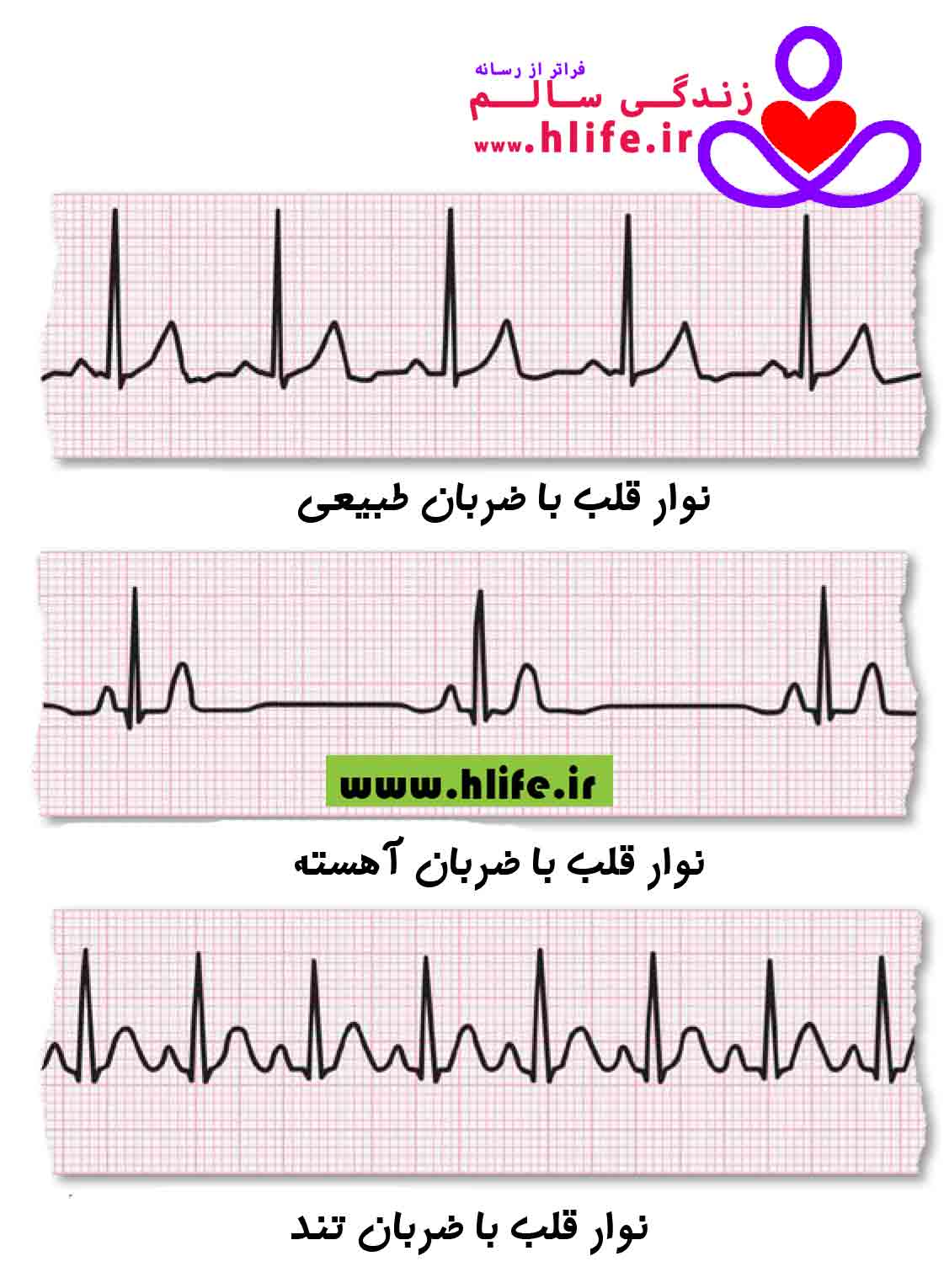 نوار قلب یا الکتروکاردیوگرام متخصص قلب و عروق