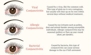 Types of Pink Eye 300x182 - کونژنکتیویت (دلایل، علایم و انتقال)