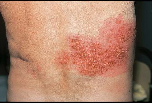 varicella zoster virus infection chest wall - هر آنچه باید از بیماری زونا بدانید.