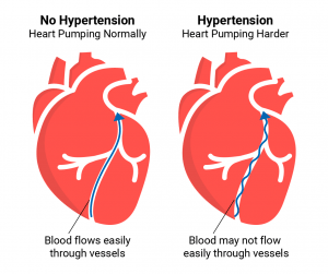 HypertensionIllustration 01 0 300x251 - hlife.ir