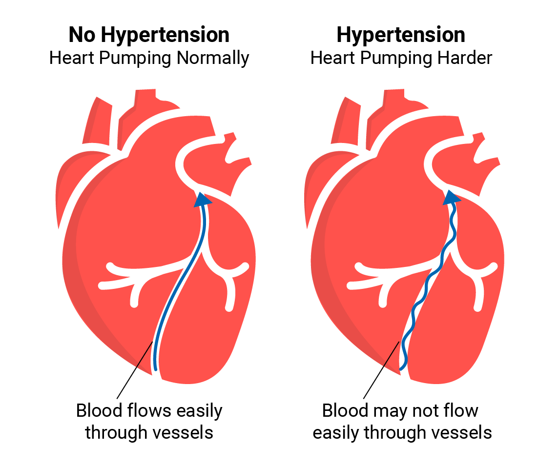HypertensionIllustration 01 0 - فشار خون بالا و هر آنچه درباره آن باید بدانید
