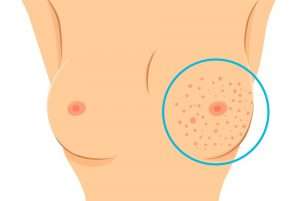 02 cancer symptoms texture change large 300x201 - سرطان پستان
