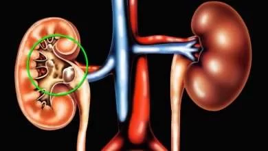 kidneys stones