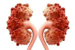 iStock 992755234 1 300x200 - kidney disease