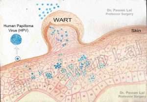 warts HPV 1b 300x208 - warts_HPV_1b