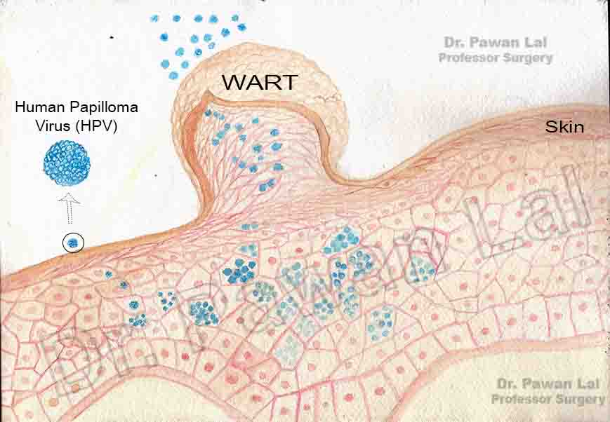 warts HPV 1b - منظور از زگیل تناسلی چیست؟