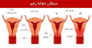 signs of cervical cancer 300x158 - signs-of-cervical-cancer